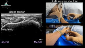 Glenohumeral Joint Capsular Distension at the Rotator Interval