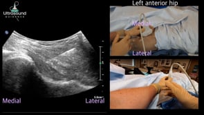 Hip Joint Injection Sagittal Approach