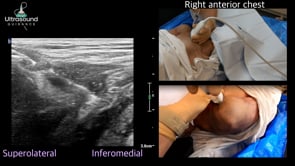 Infraclavicular Brachial Plexus Injection