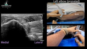 Common Extensor Tendon Needle Tenotomy Short Axis