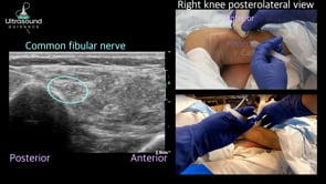 Common Fibular Nerve Hydrodissection