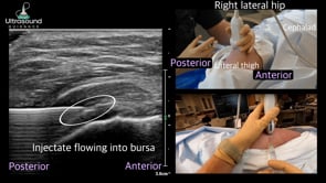 Subgluteus Maximus/Greater Trochanter Bursa Injection