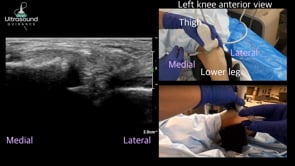 Medial Subpatellar Knee Injection