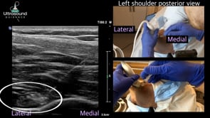 Suprascapular Nerve Injection at the Suprascapular Notch