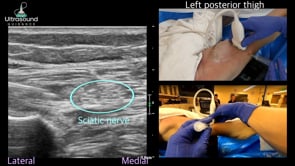 Sciatic Nerve Hydrodissection in the Thigh