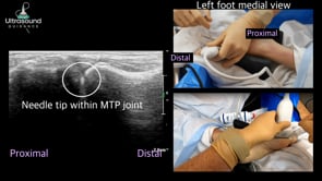 First MTP Joint Injection