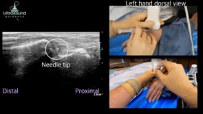 First CMC Joint Injection