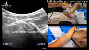 Posterior Glenohumeral Joint Injection