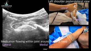 Glenohumeral Joint Capsular Distension Posterior Approach