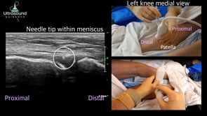 Medial Meniscus Injection