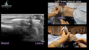 Patellar Tendon Needle Tenotomy