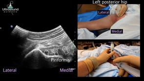 Piriformis Injection and Sciatic Nerve Hydrodissection