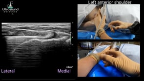 Glenohumeral Joint Injection via the Rotator Interval