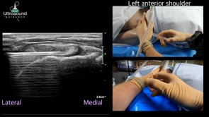 Glenohumeral Joint Injection via the Rotator Interval