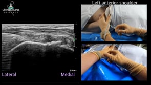 Combined Biceps Tendon Sheath and SASD Bursa Injection