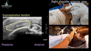 Subacromial/Subdeltoid (SASD) Bursa Injection Sidelying