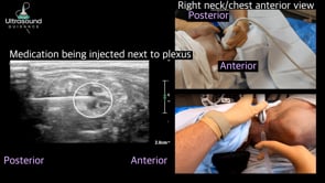 Supraclavicular Brachial Plexus Injection