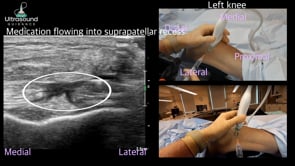 Suprapatellar Recess Knee Injection