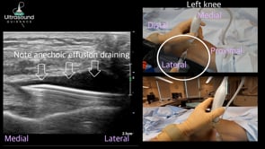 Suprapatellar Recess Knee Drainage