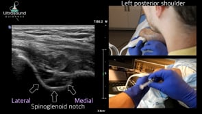 Suprascapular Nerve Injection at the Spinoglenoid Notch