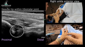 Ankle Joint Injection Distal to Proximal Approach