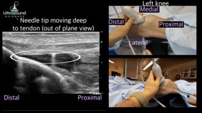 Patellar Tendon Scraping