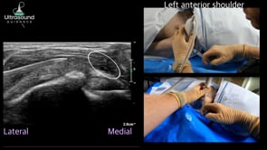 Subacromial/Subdeltoid Bursa Injection Supine