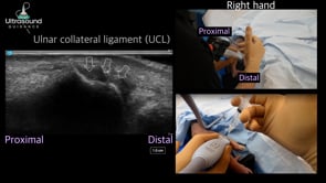 Ulnar Collateral Ligament of the Thumb Injection