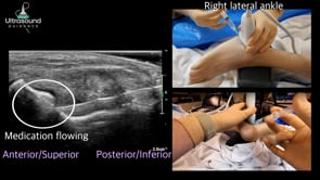 Subtalar Joint Injection Lateral Approach
