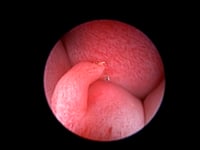 Endoscopic diode laser ablation paramesonephric remnant
