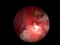 EVR Laser Ablation Nasal Adenocarcinoma