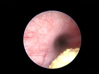 EVR Laparoscopic Cystoscopy