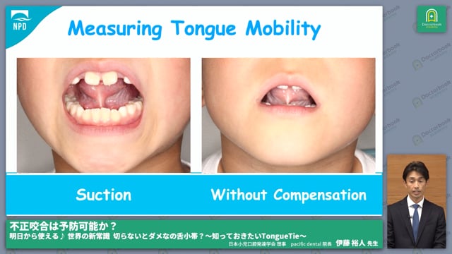 タングタイと舌小帯短縮 なにが違うの？ #3