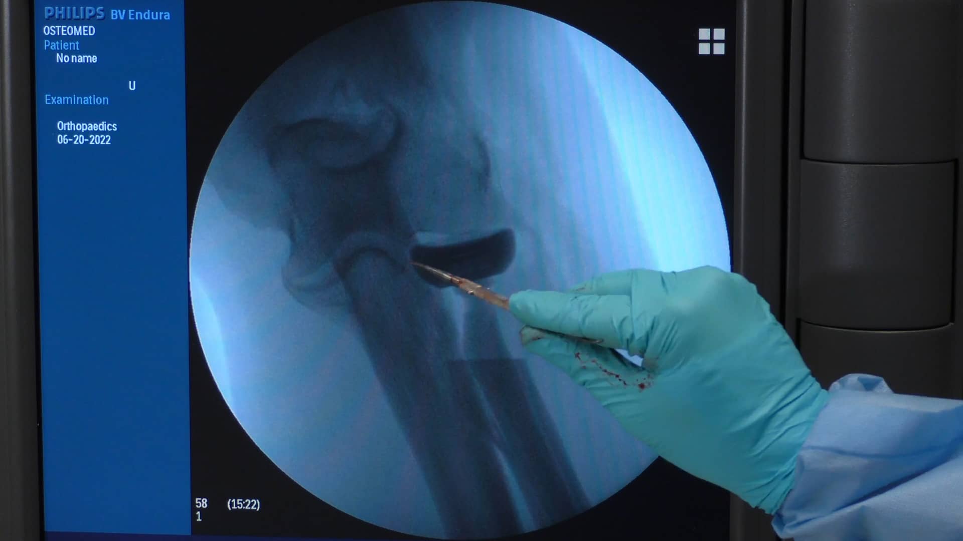Radial Head Fracture Replacement Using the Long Stem Acumed Anatomic