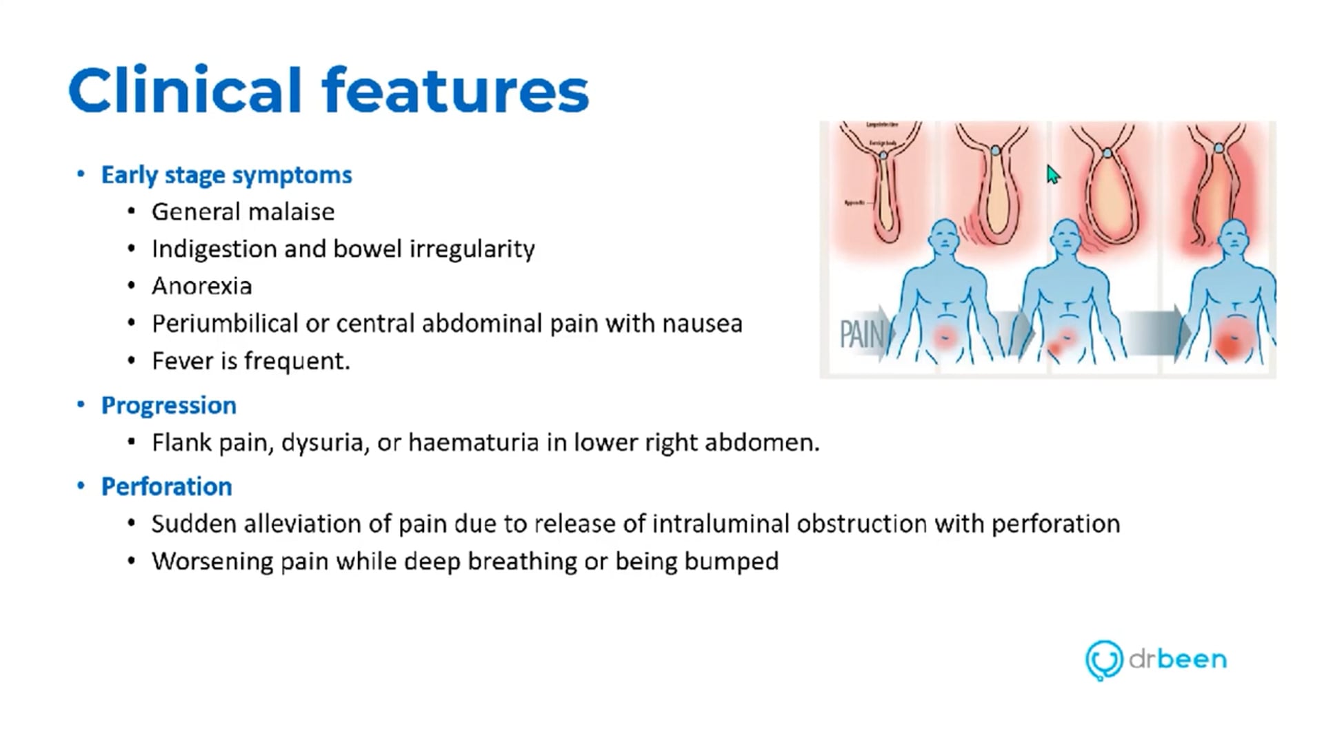 Acute Appendicitis (Dr. Bhatti)