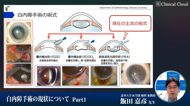 白内障手術の現状について　Part1