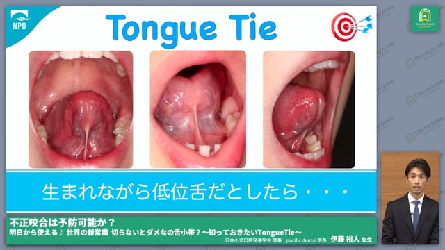 不正咬合とタングタイ 根本原因 #2