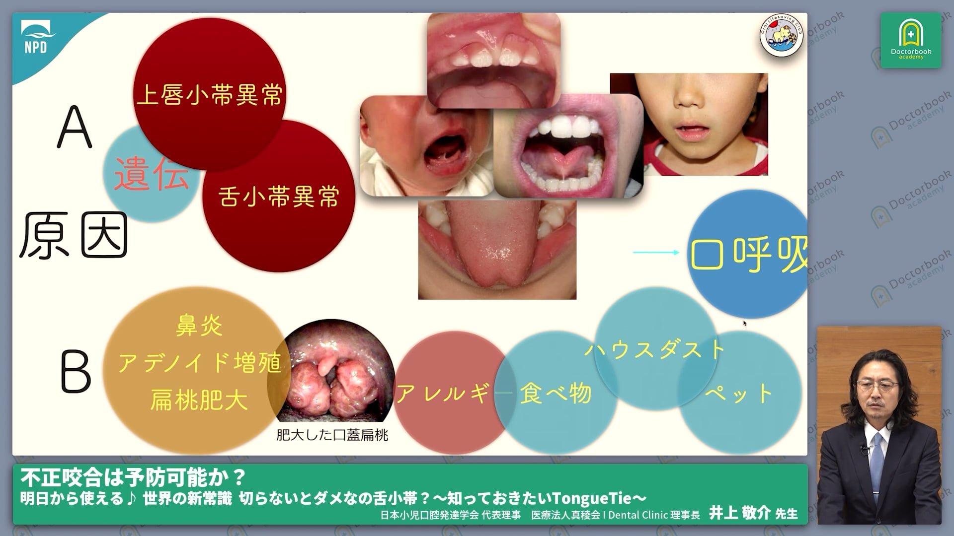 舌小帯の口腔機能発達不全症に対する影響 #1
