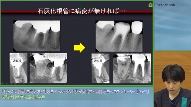 開かない根管に遭遇したら？｜対処法と使用する器具 #1