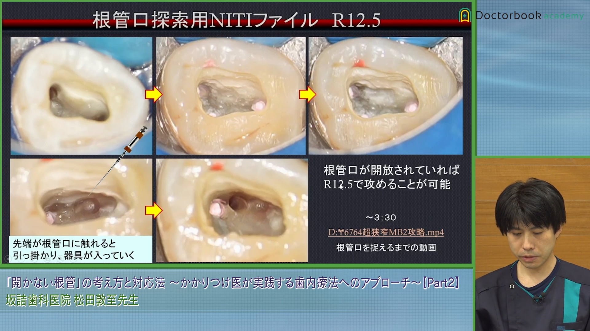 根管口から根管中央の問題とは？～狭窄している根管の治療法～ #2