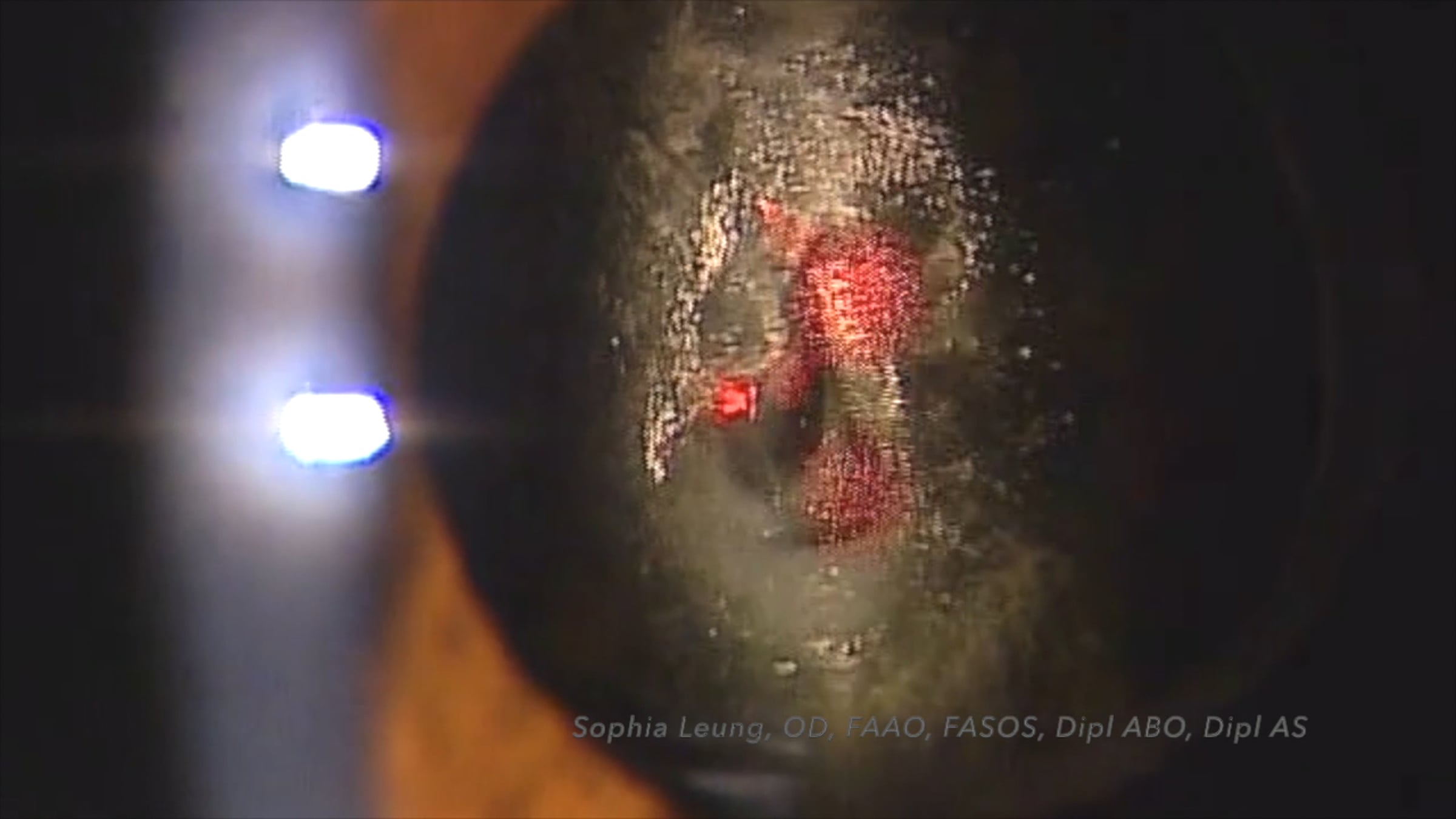 YAG Capsulotomy for Posterior Capsular Distension Syndrome