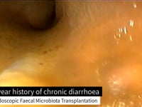 EVR Endoscopic Faecal Microbiota Transplant Promo