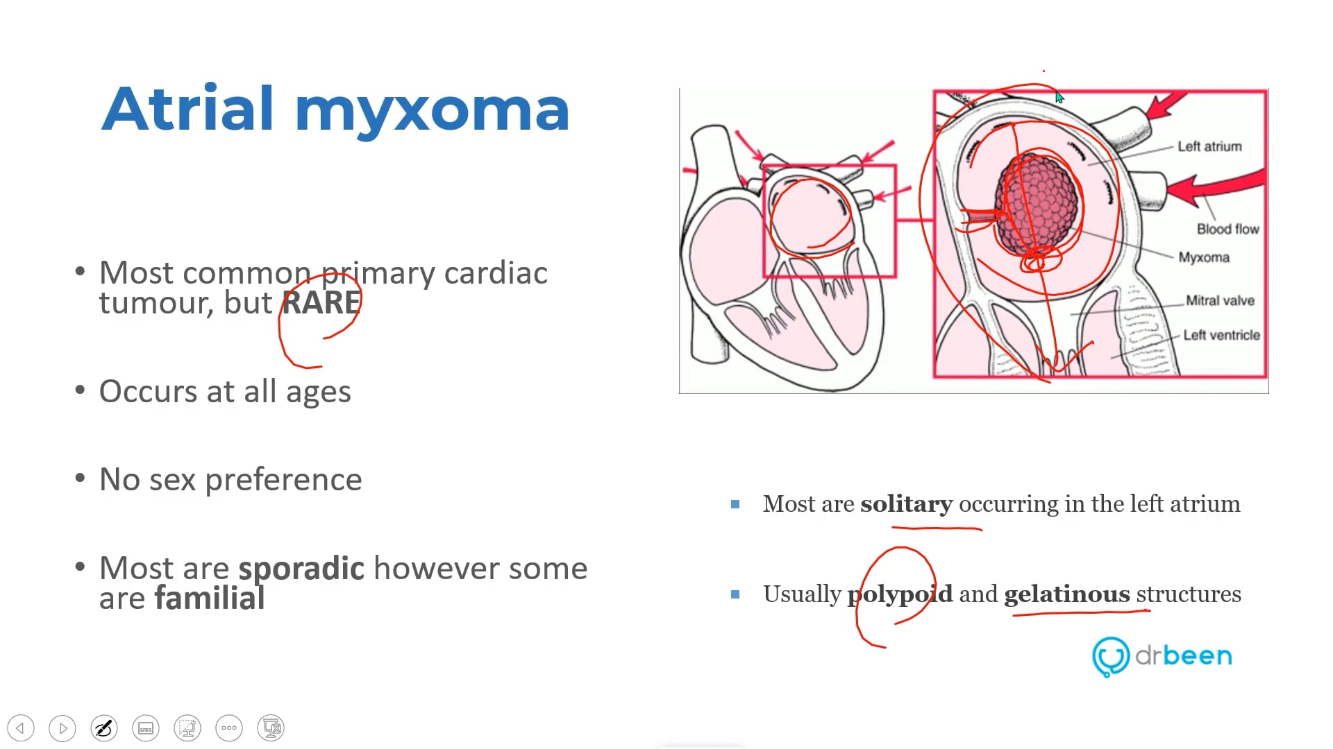 Atrial Myxoma (Dr. Bhatti)