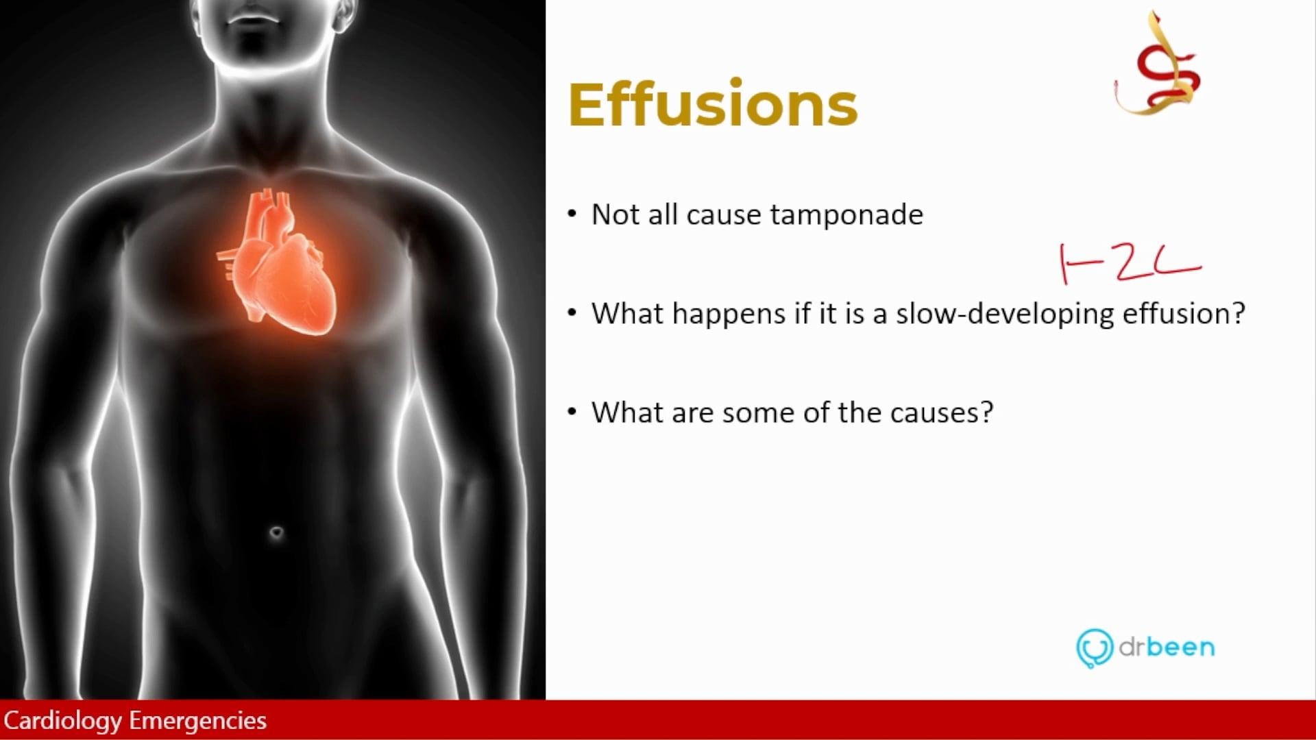 Pericardial Effusion and Tamponade (Dr. Bhatti)