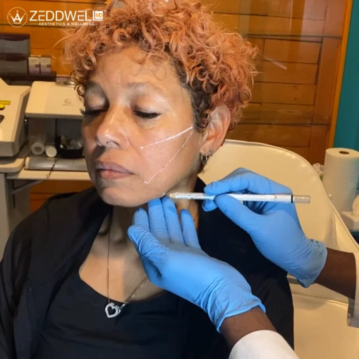 Nonsurgical Facelift | Jacksonville Florida – GoBeyond Wellness Center