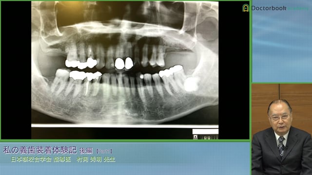 下顎総義歯装着に至るまで。様々な部分床義歯の体験 #1