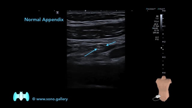 Normal Appendix