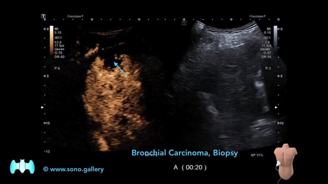 Bronchial Carcinoma, Biopsy