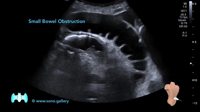 Small Bowel Obstruction