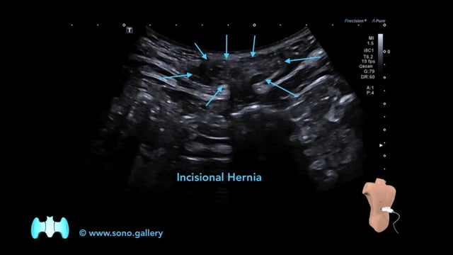 Incisional Hernia
